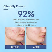 Fixderma Salyzap 2% Salicylic Acid Acne Spot Corrector Gel with 2% Niacinamide Acid & 1% Aczero | Reduce Active Acne & Redness | Fades Dark Spots & Blemishes | Pimple Remover For Men & Women - 20g